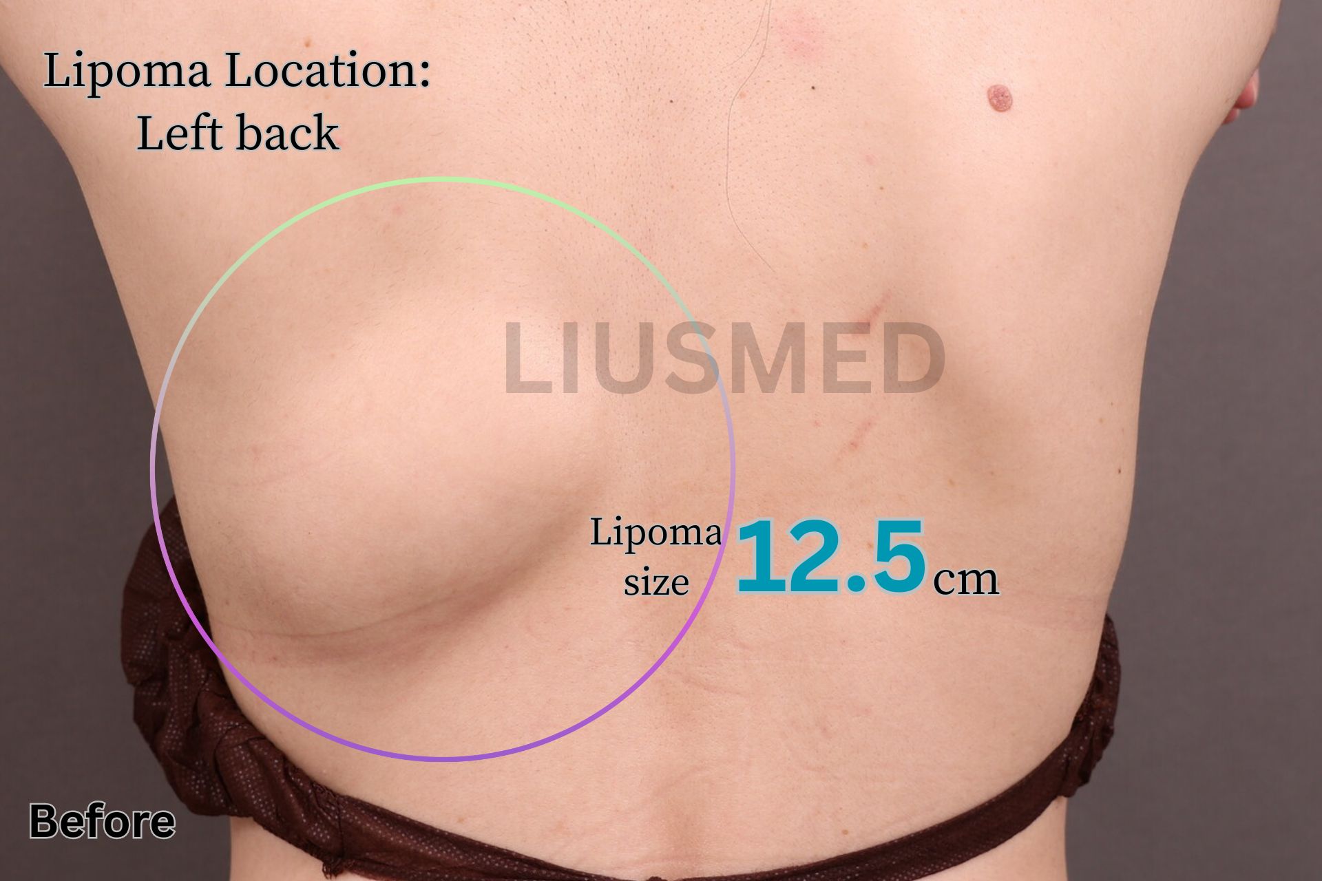 지방종 - 왼쪽 등 시술 전