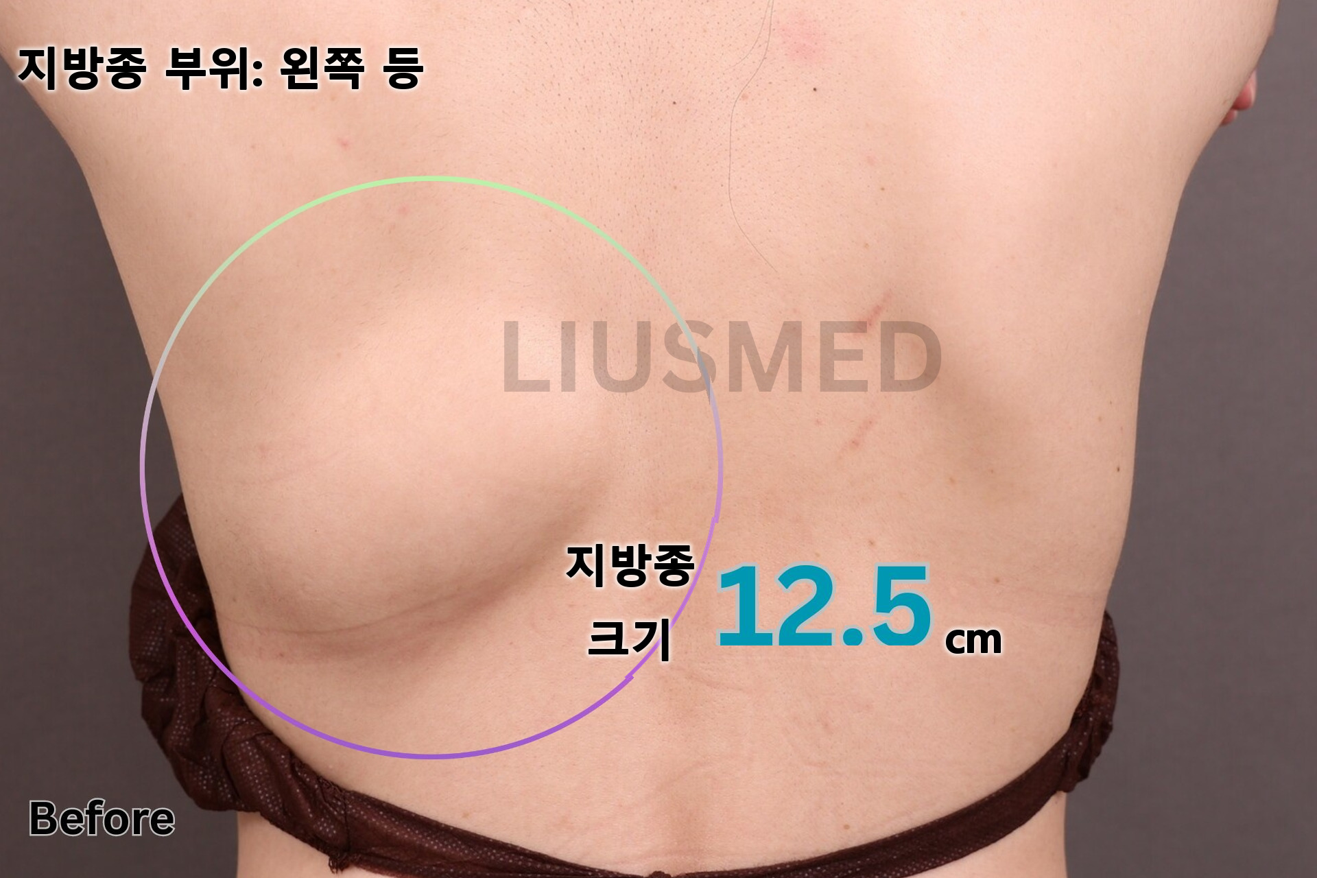 지방종 - 왼쪽 등 시술 전