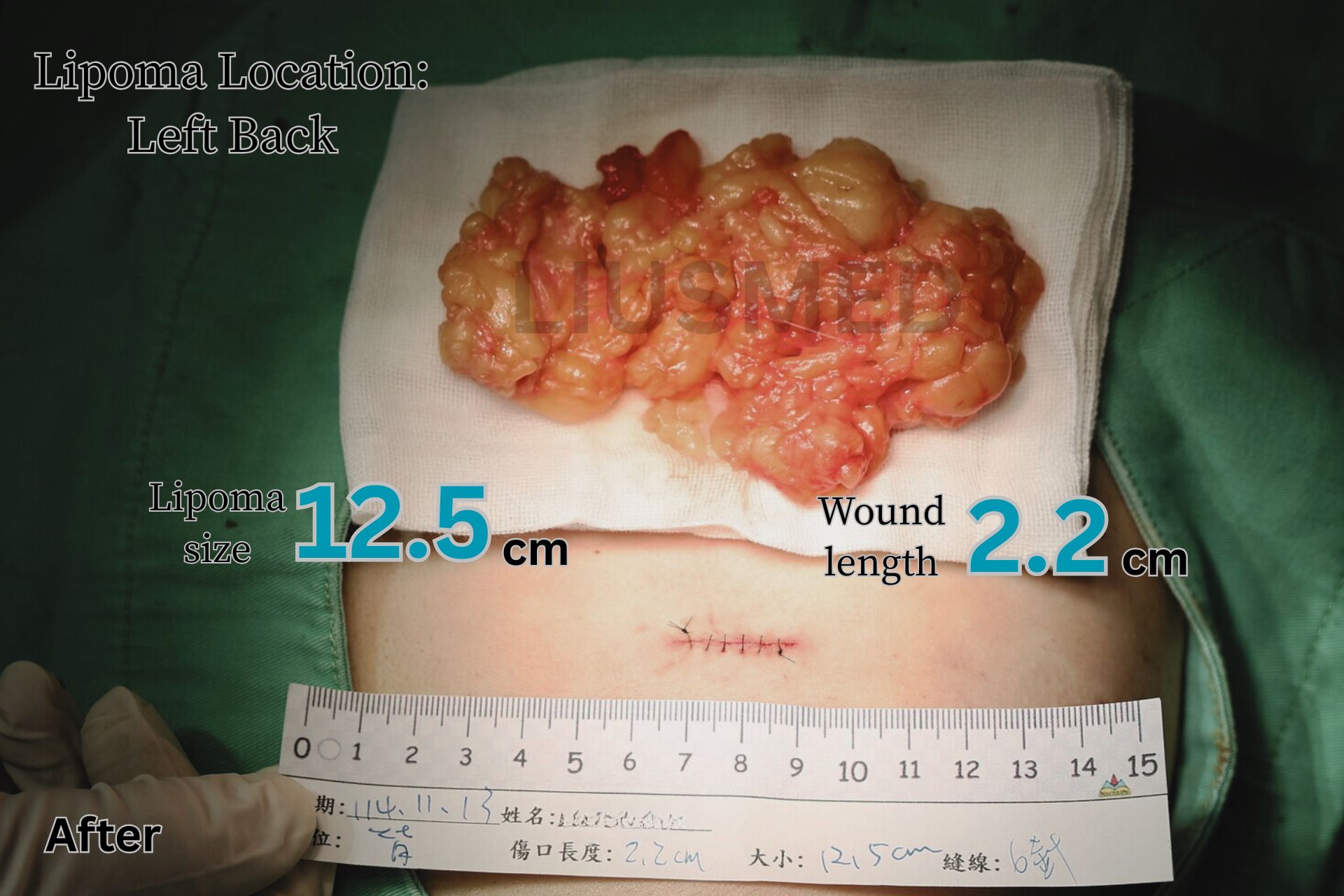 수술 후 - 왼쪽 등