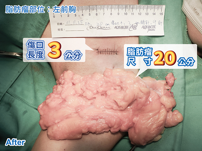 術後 - 左前胸
