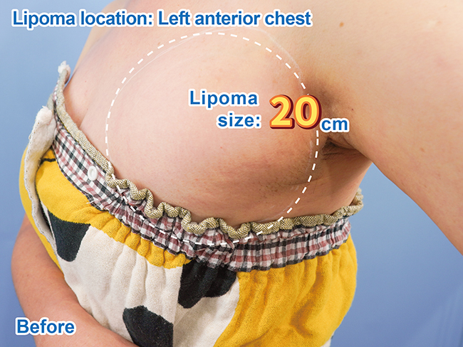 지방종 - 왼쪽 전흉부 시술 전