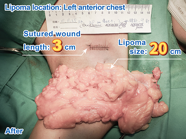 수술 후 - 왼쪽 전흉부