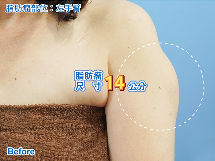 脂肪瘤 - 左上臂 術前