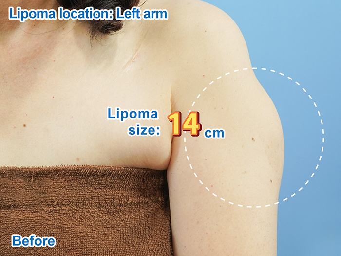지방종 - 왼쪽 상완 시술 전