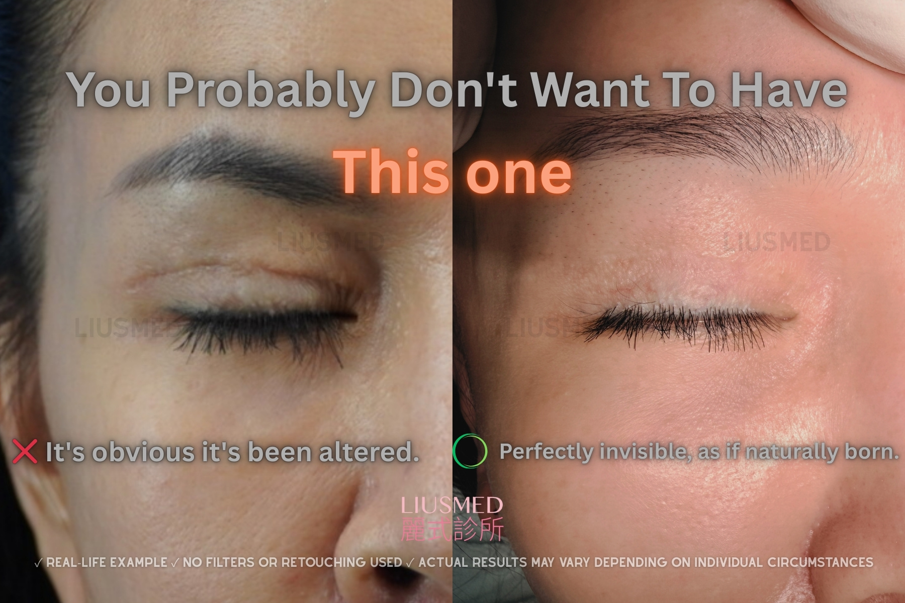 흉터 수복 - 쌍꺼풀 시술 전