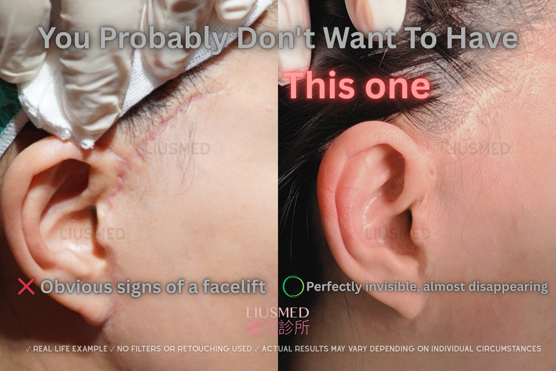 흉터 수복 - 이전부 헤어라인 시술 전