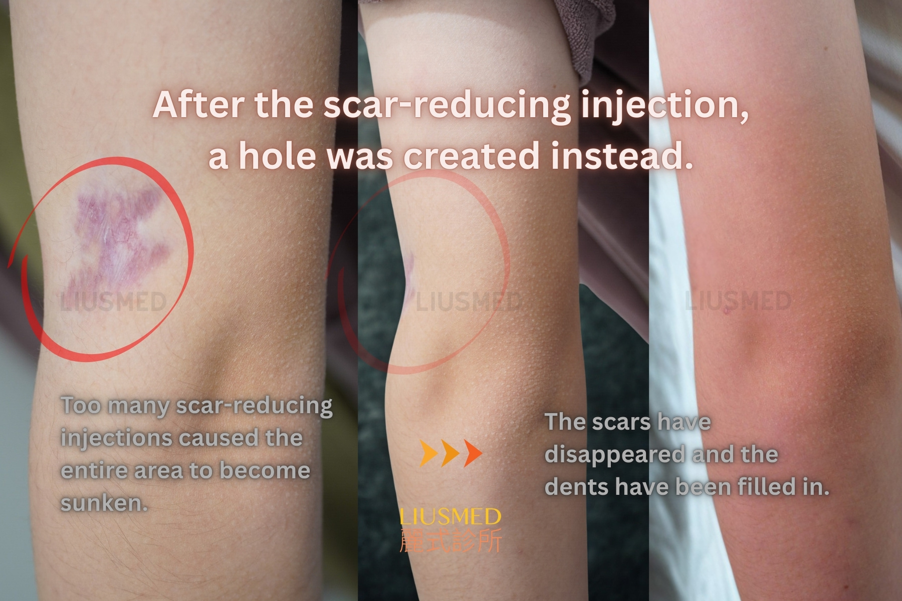 흉터 수복 - 손등 시술 전