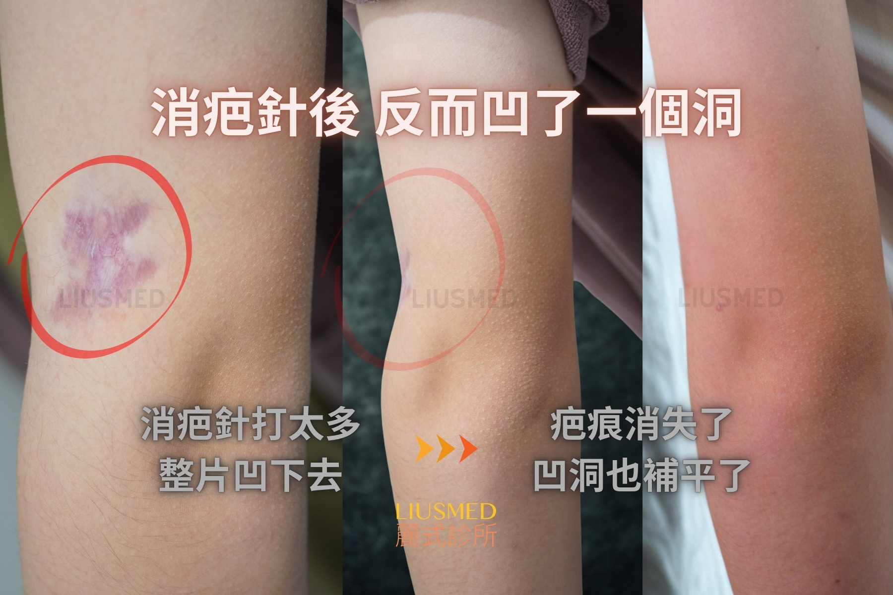 疤痕修復 - 手背 術前