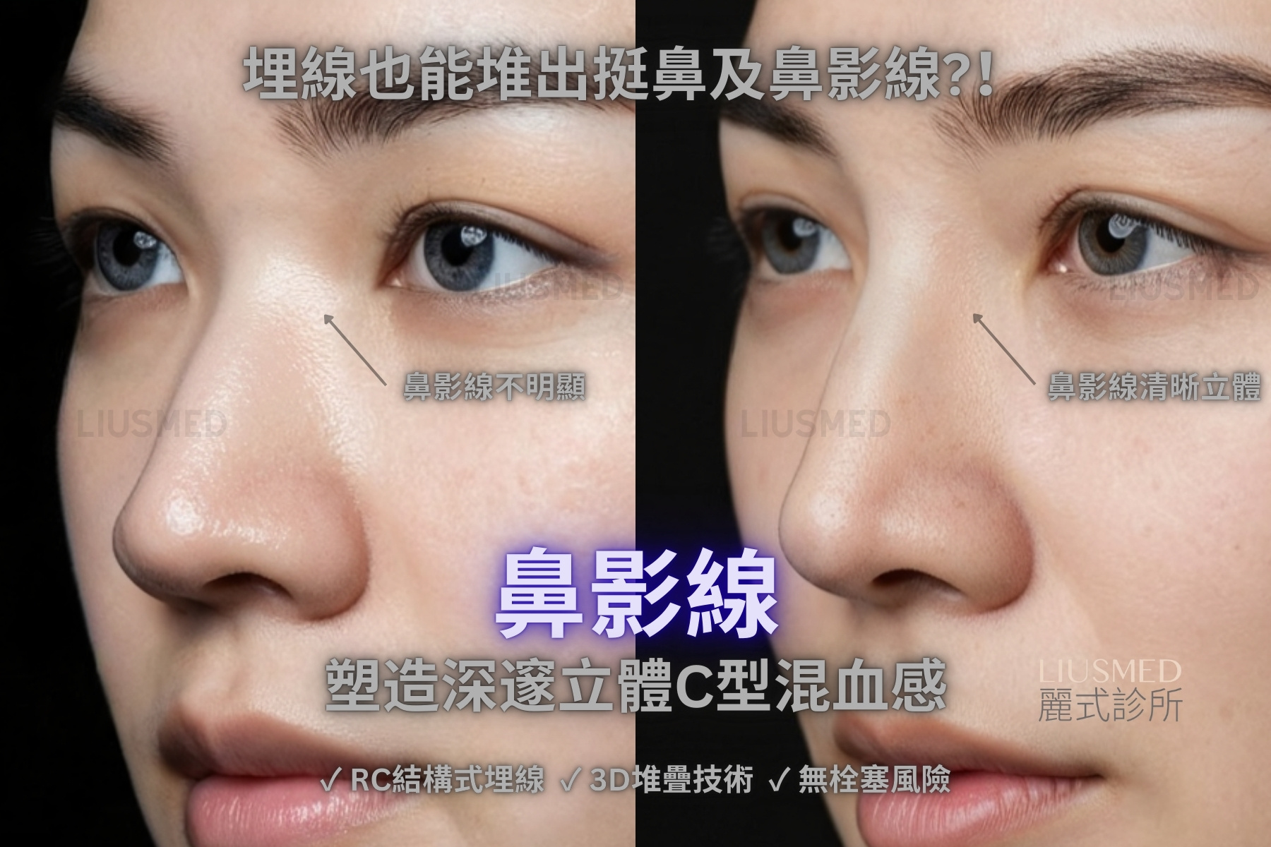 線雕 - 鼻部 術前