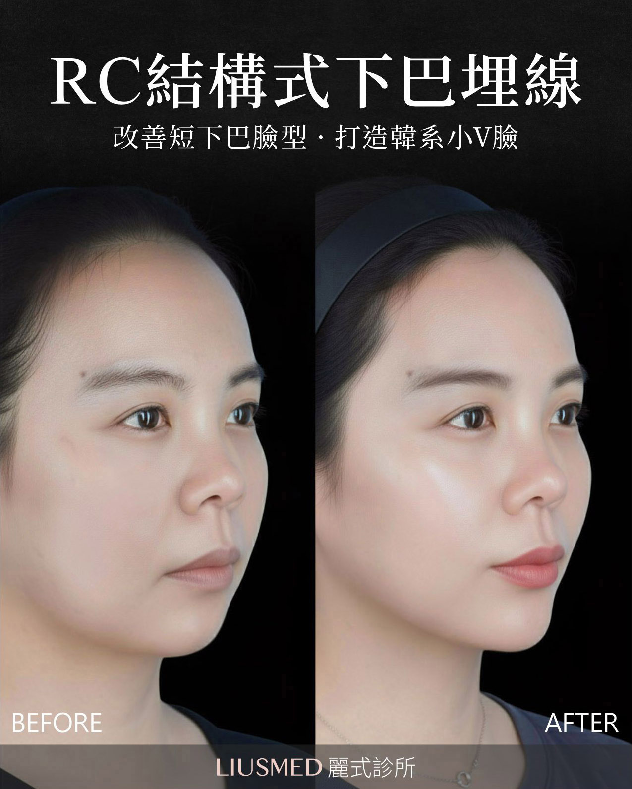 線雕 - 下巴 術前