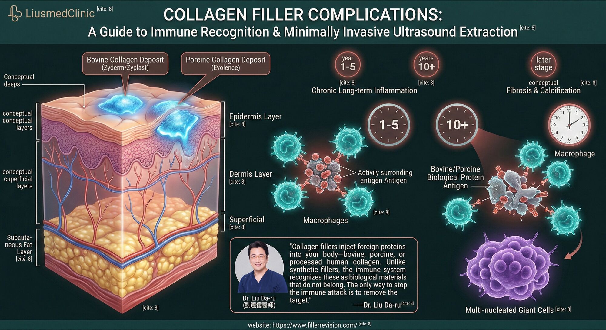 Collagen Fillers