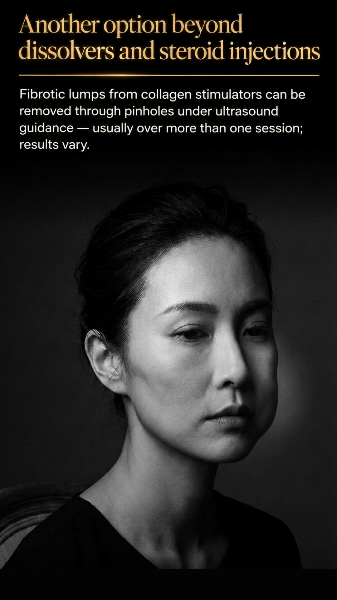Another option beyond dissolvers and steroid injections: fibrotic lumps removed through pinholes under ultrasound guidance