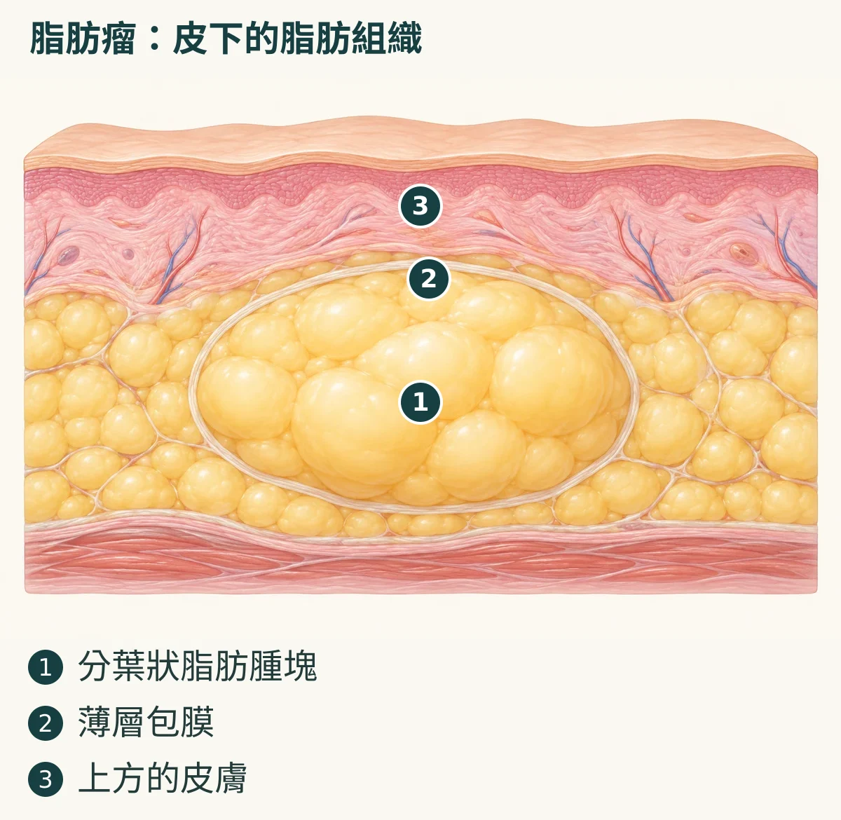 脂肪瘤：皮下的脂肪組織（1. 分葉狀脂肪腫塊；2. 薄層包膜；3. 上方的皮膚）