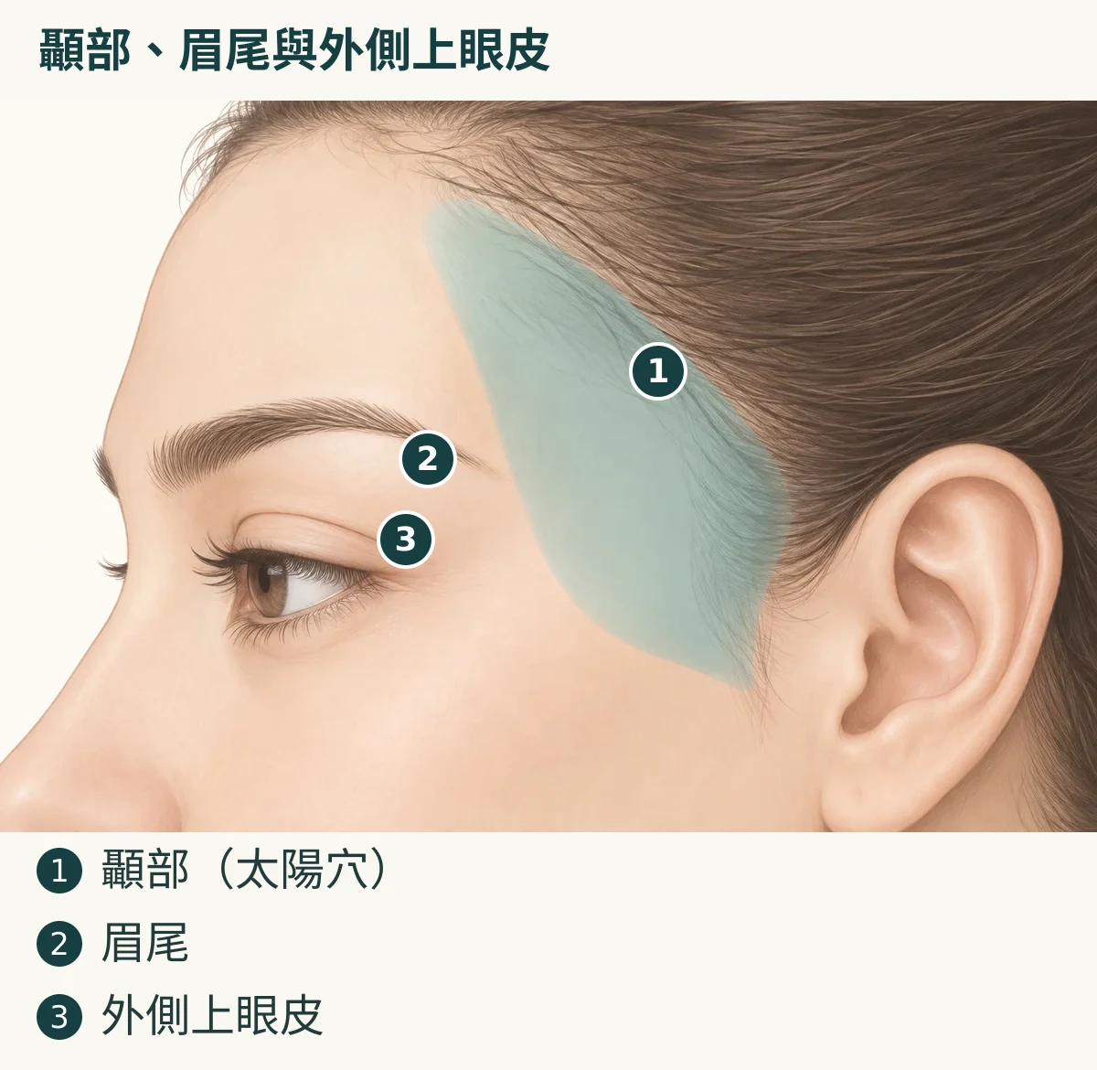 顳部、眉尾與外側上眼皮（1. 顳部（太陽穴）；2. 眉尾；3. 外側上眼皮）