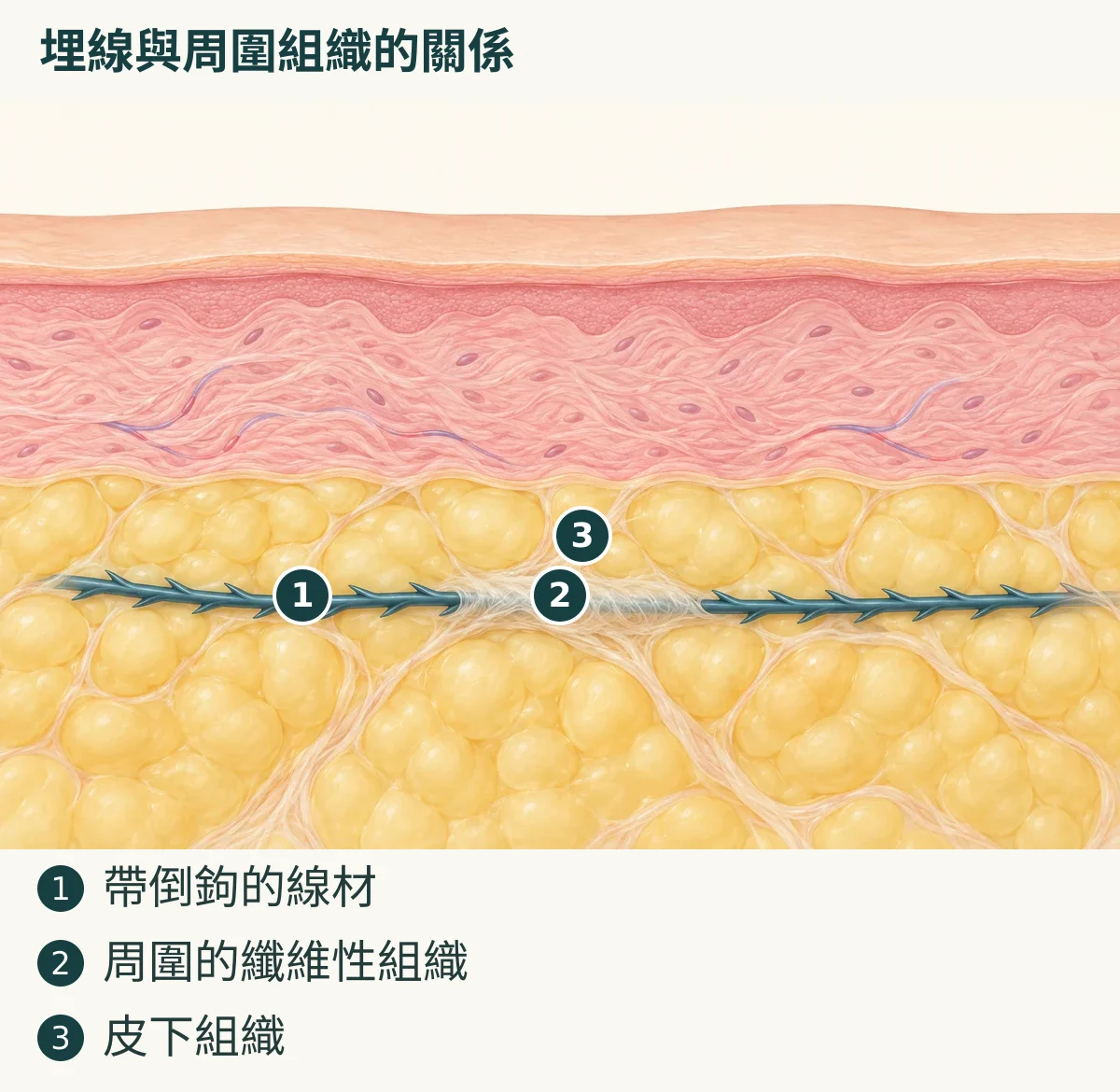 埋線與周圍組織的關係（1. 帶倒鉤的線材；2. 周圍的纖維性組織；3. 皮下組織）