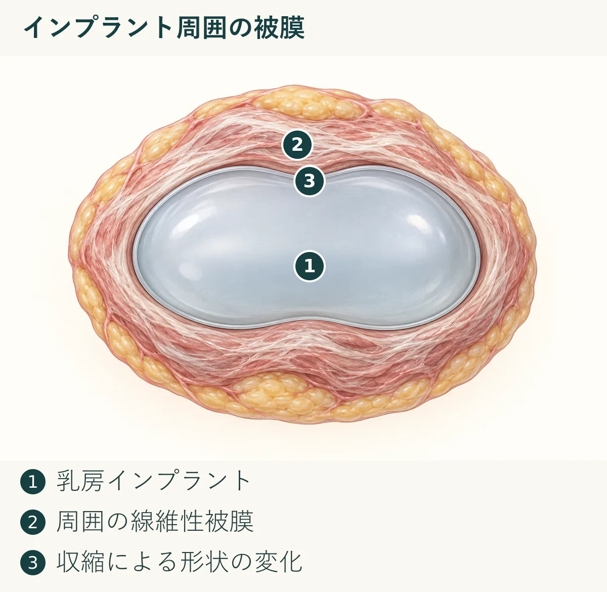 インプラント周囲の被膜（1. 乳房インプラント、2. 周囲の線維性被膜、3. 収縮による形状の変化）