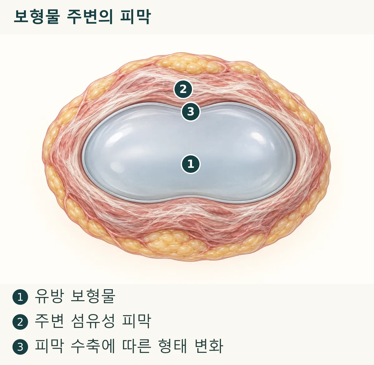 보형물 주변의 피막 (1. 유방 보형물, 2. 주변 섬유성 피막, 3. 피막 수축에 따른 형태 변화)