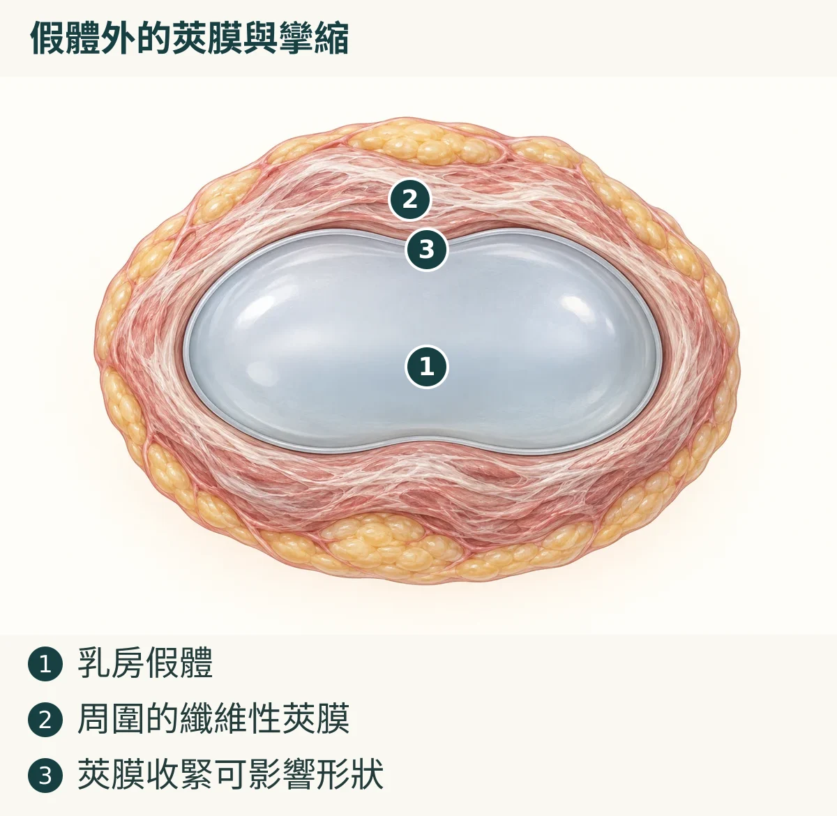 假體外的莢膜與攣縮（1. 乳房假體；2. 周圍的纖維性莢膜；3. 莢膜收緊可影響形狀）