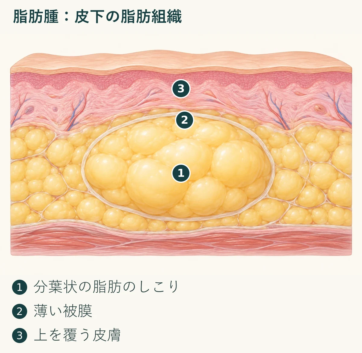 脂肪腫：皮下の脂肪組織（1. 分葉状の脂肪のしこり、2. 薄い被膜、3. 上を覆う皮膚）