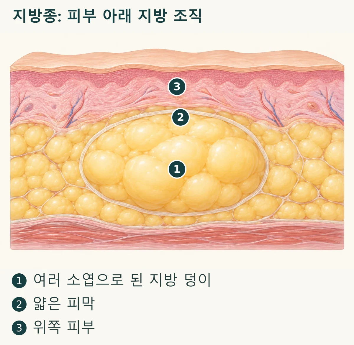 지방종: 피부 아래 지방 조직 (1. 여러 소엽으로 된 지방 덩이, 2. 얇은 피막, 3. 위쪽 피부)