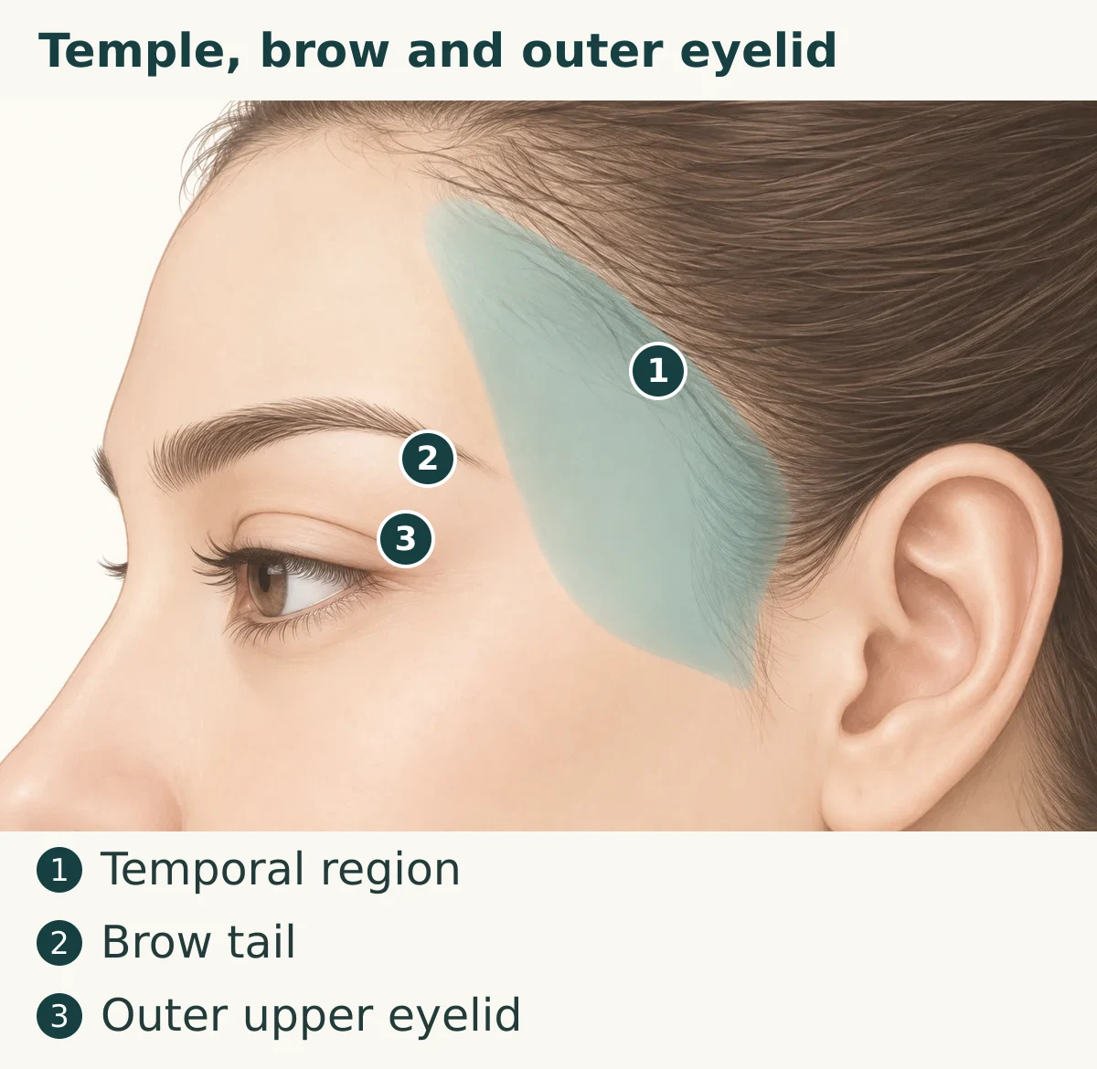 Temple, brow and outer eyelid (1. Temporal region; 2. Brow tail; 3. Outer upper eyelid)