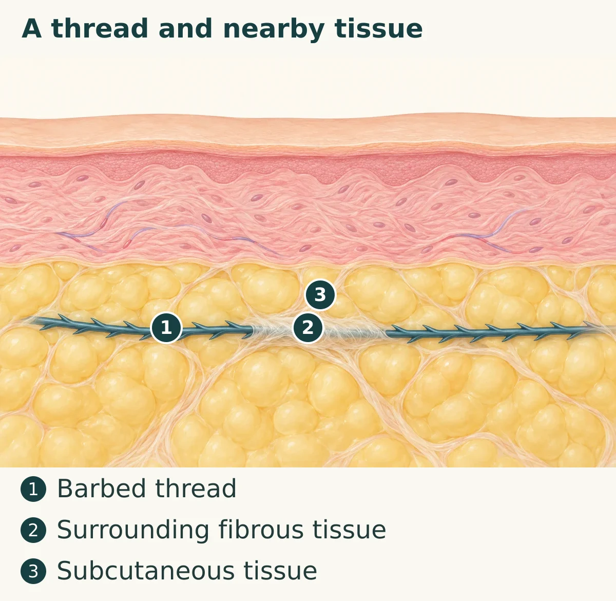 A thread and nearby tissue (1. Barbed thread; 2. Surrounding fibrous tissue; 3. Subcutaneous tissue)