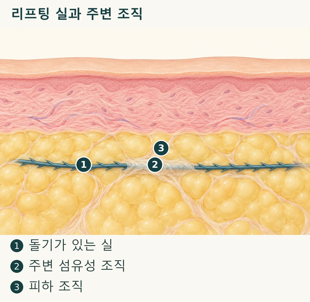 리프팅 실과 주변 조직 (1. 돌기가 있는 실, 2. 주변 섬유성 조직, 3. 피하 조직)