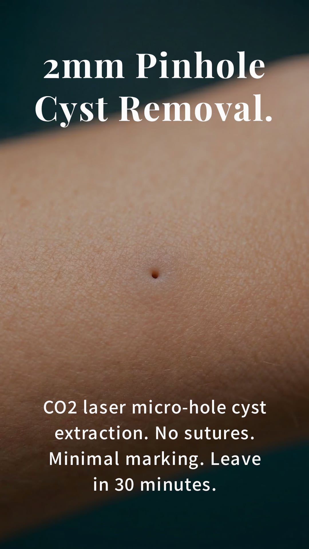 2mm Pinhole Cyst Removal. — CO2 laser micro-hole cyst extraction.