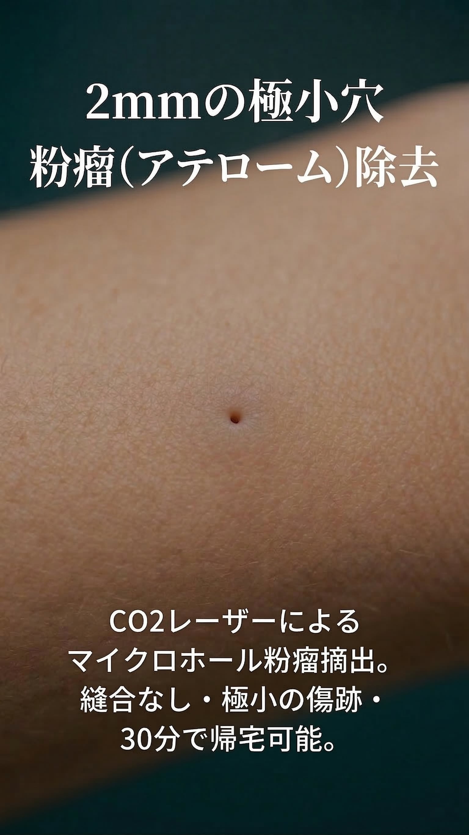 2mmの極小穴 粉瘤除去 — CO2レーザーによるマイクロホール粉瘤摘出。