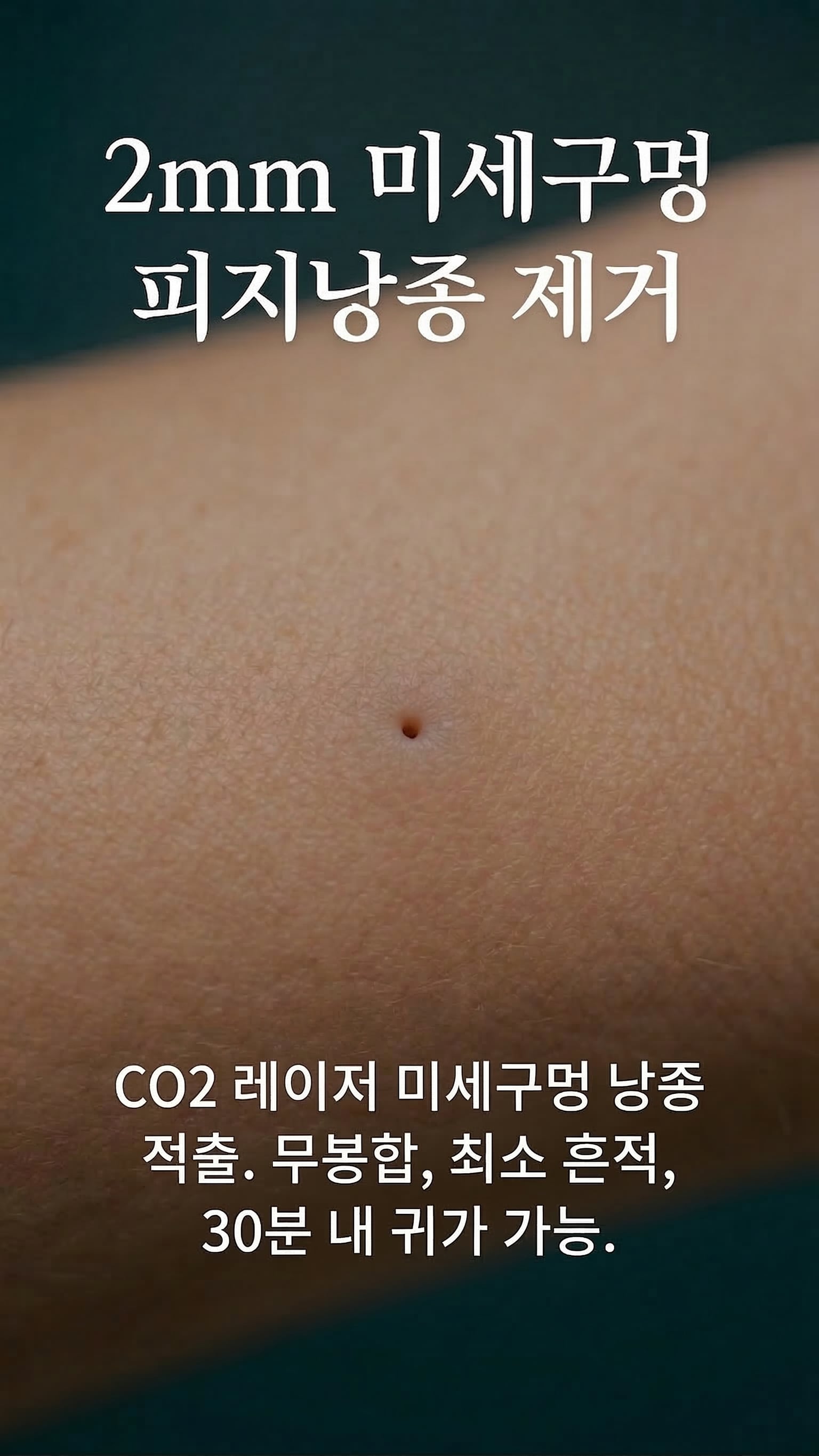 2mm 미세구멍 피지낭종 제거 — CO2 레이저 미세구멍 낭종 적출.