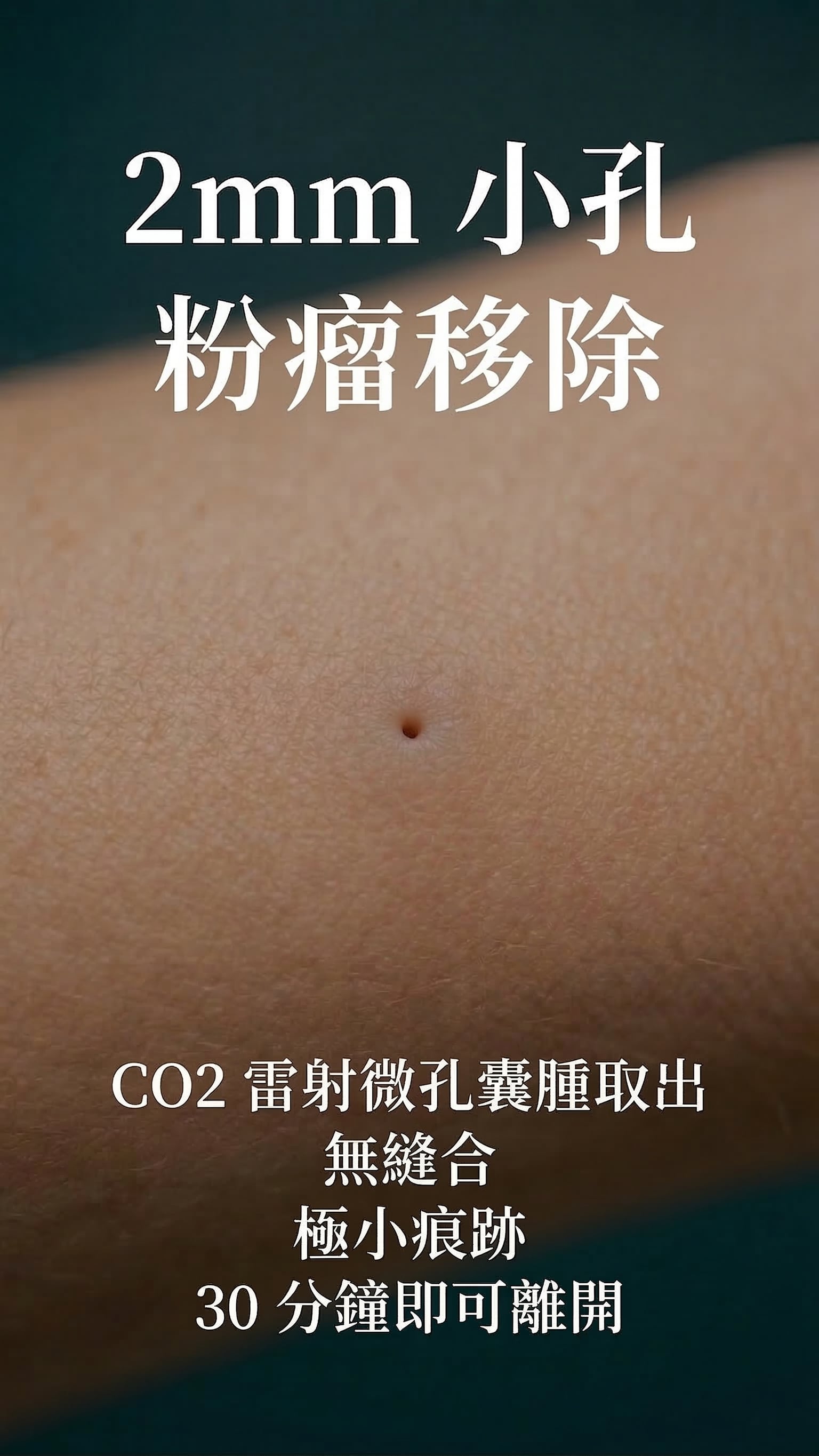 2mm 小孔 粉瘤移除 — CO2 雷射微孔囊腫取出