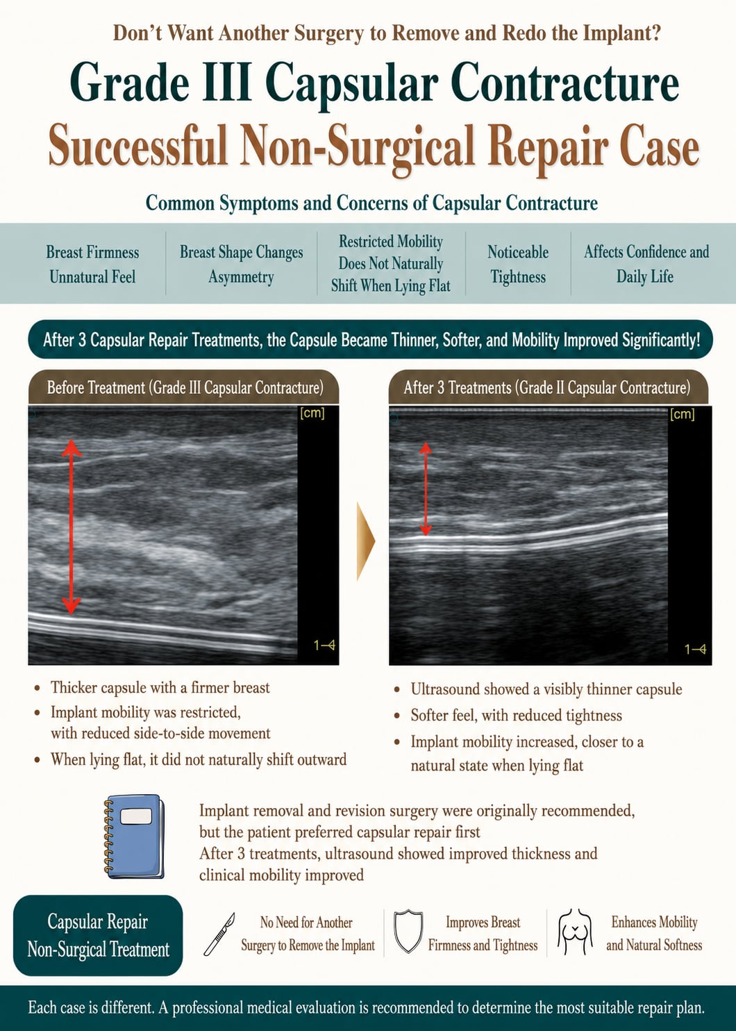 One Breast Turned Hard and Wouldn't Move — A Non-Surgical Option for Grade III Capsular Contracture