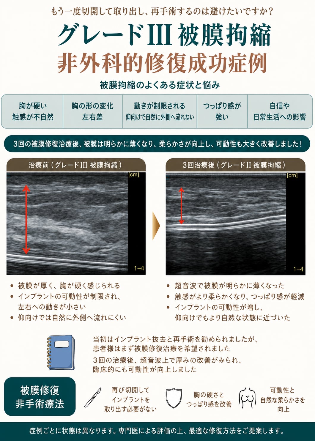 片側の胸が硬くなり動かない——再手術したくない方への、グレードIII被膜拘縮の別の選択肢