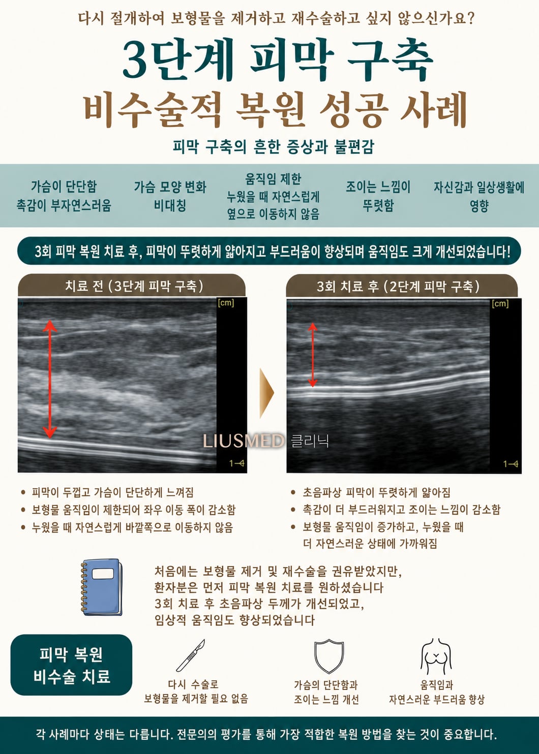 한쪽 가슴이 딱딱해지고 움직이지 않을 때——재수술을 원치 않는 분을 위한 3기 피막 구축의 또 다른 선택