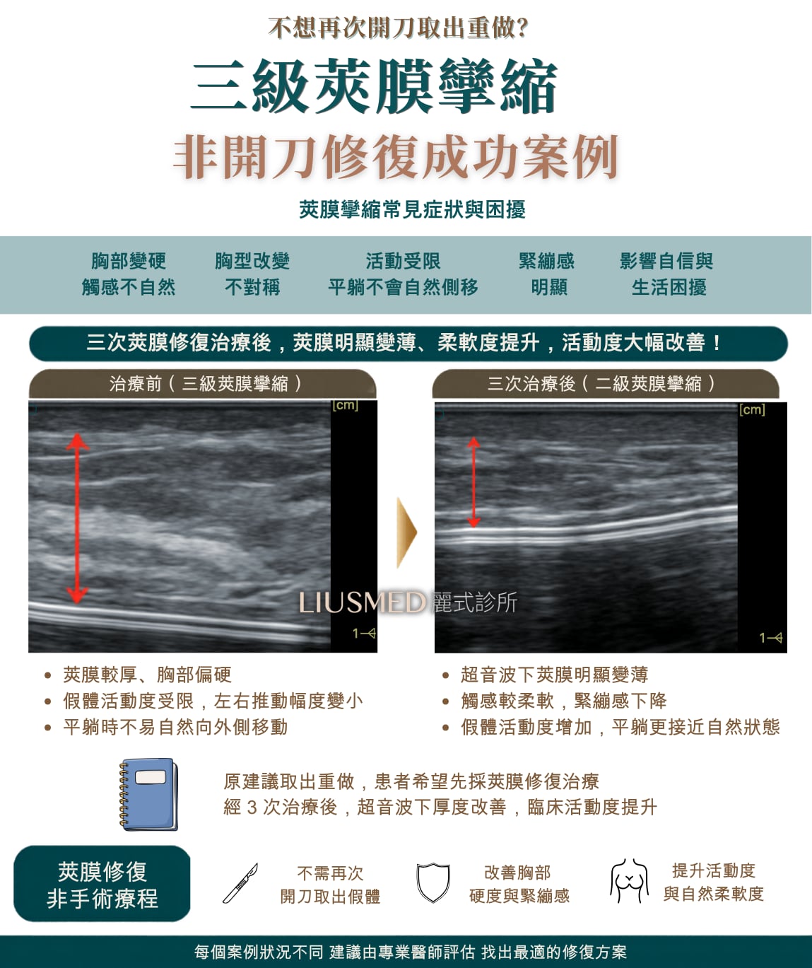 一邊胸部變硬、推不動——三級莢膜攣縮,不想再開刀的另一個選擇