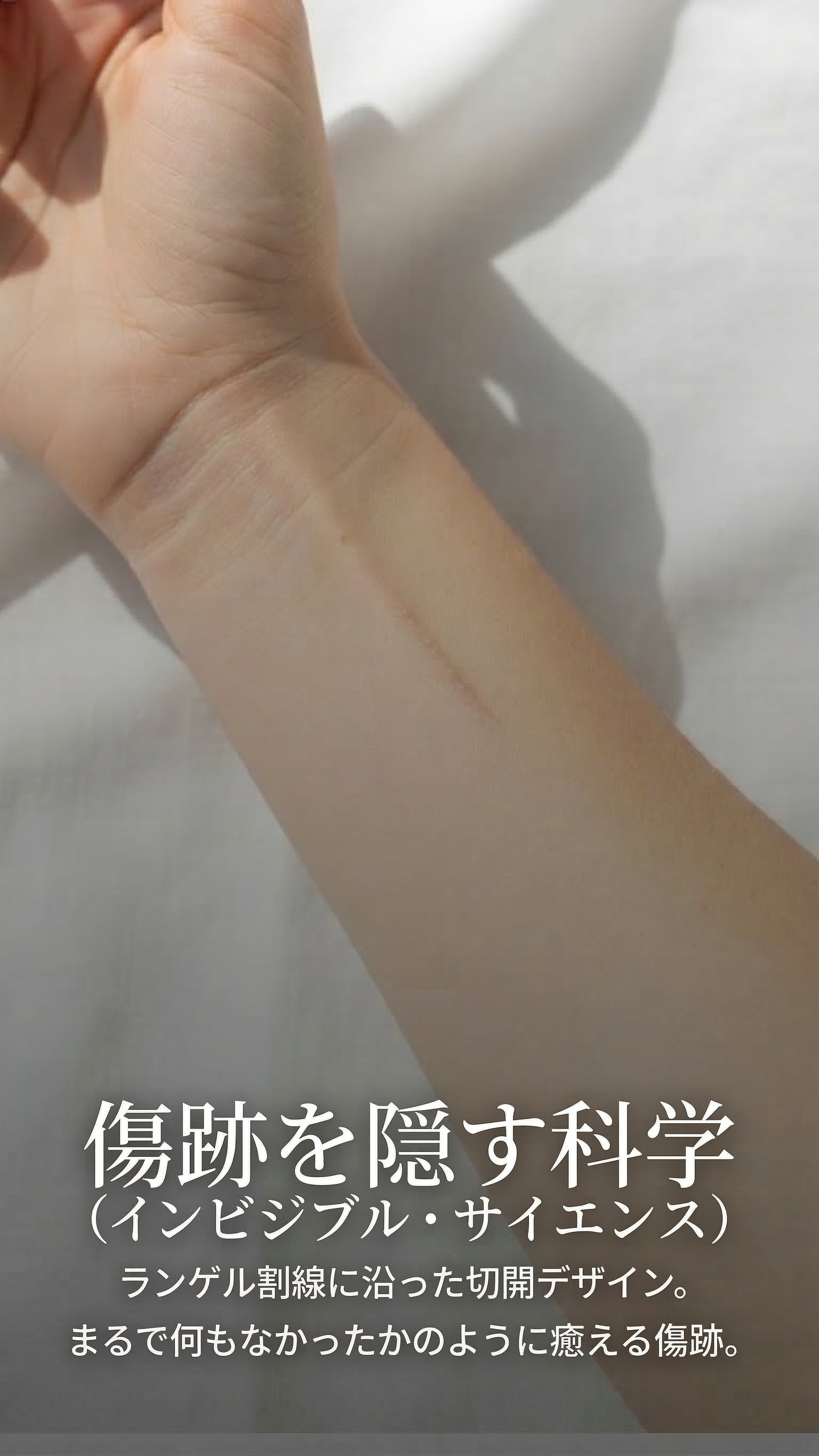 傷跡を隠す科学 — ランゲル割線に沿った切開デザイン。
