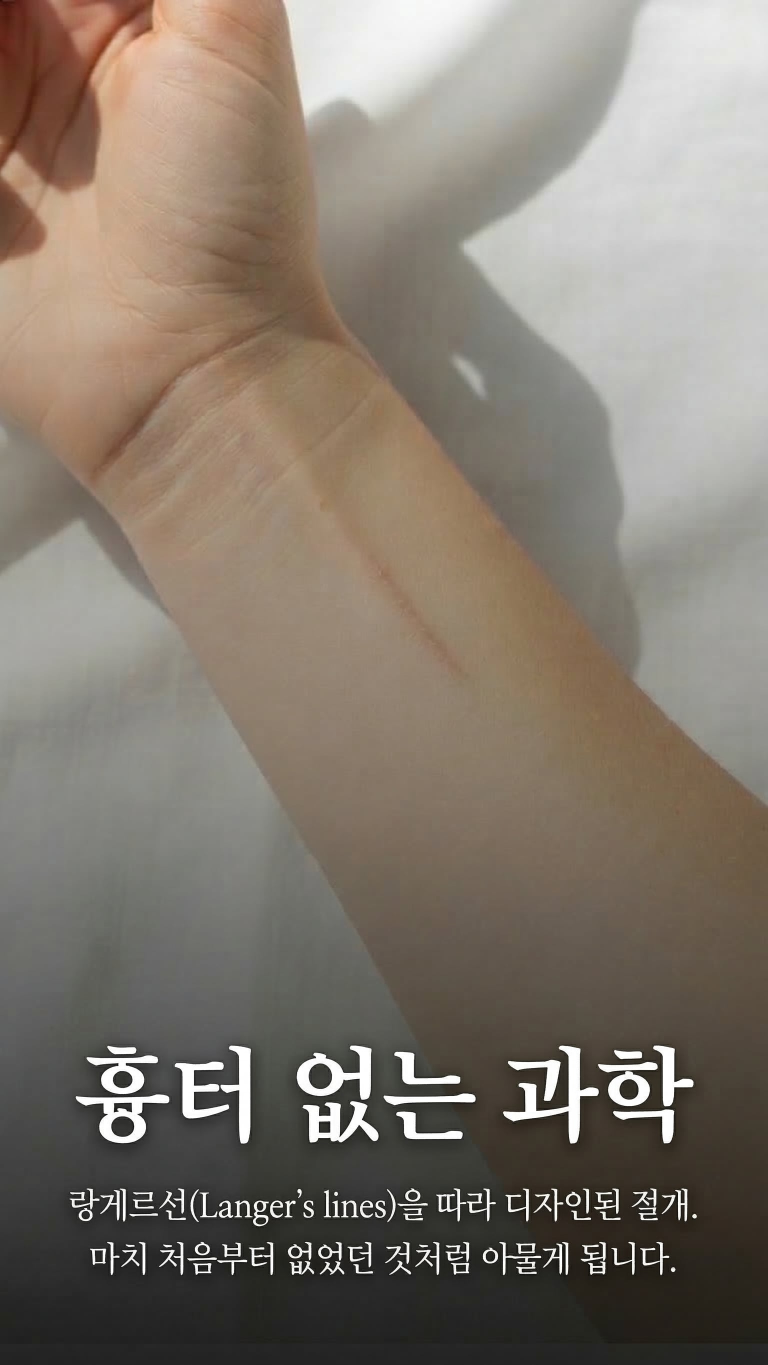 흉터 없는 과학 — 랑게르선을 따라 디자인된 절개.