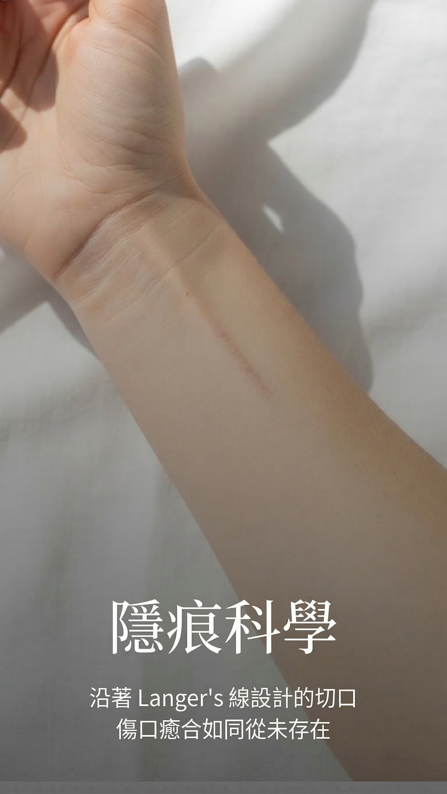 隱痕科學 — 沿著 Langer's 線設計的切口