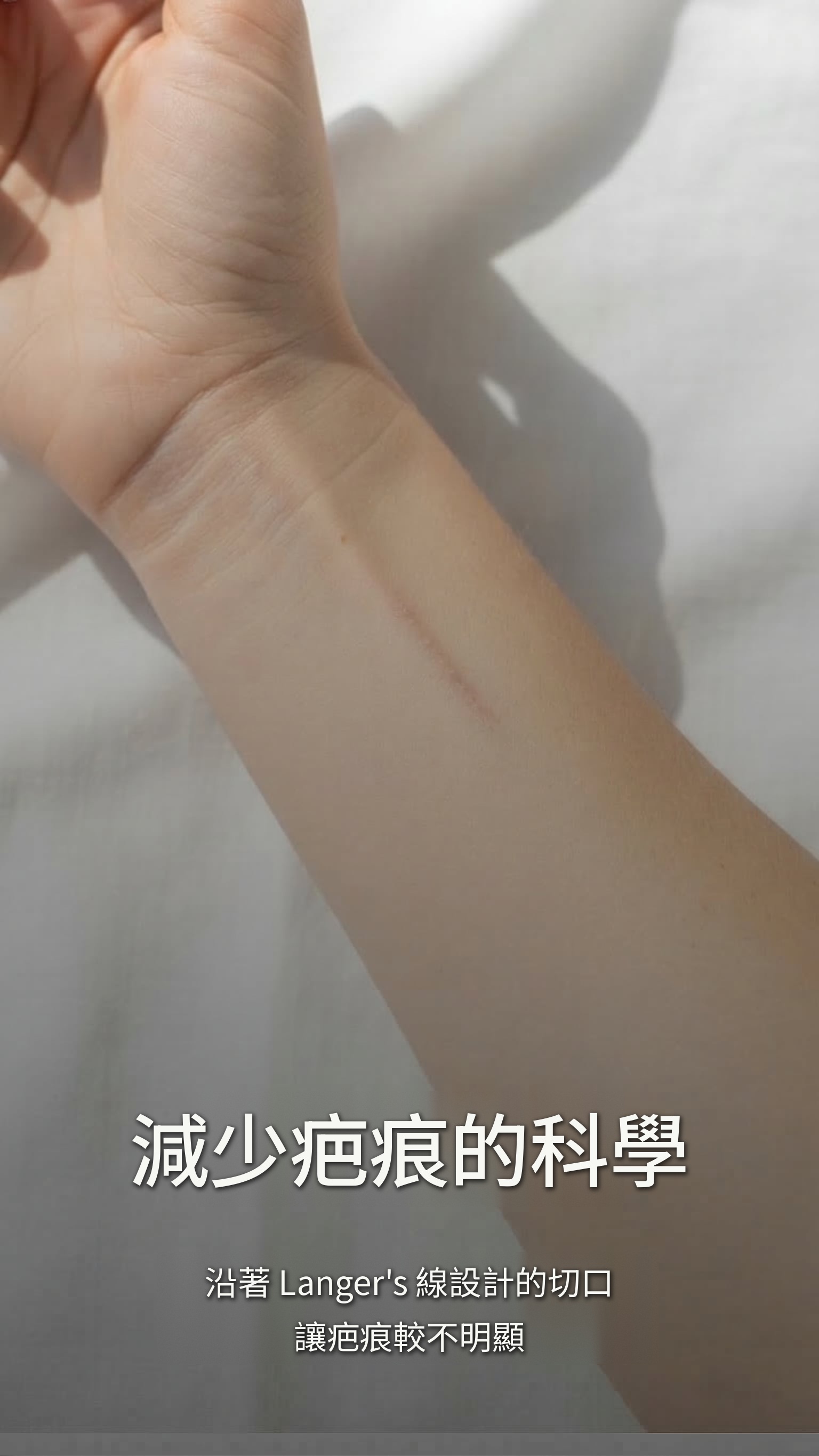 減少疤痕的科學 — 沿著 Langer's 線設計的切口