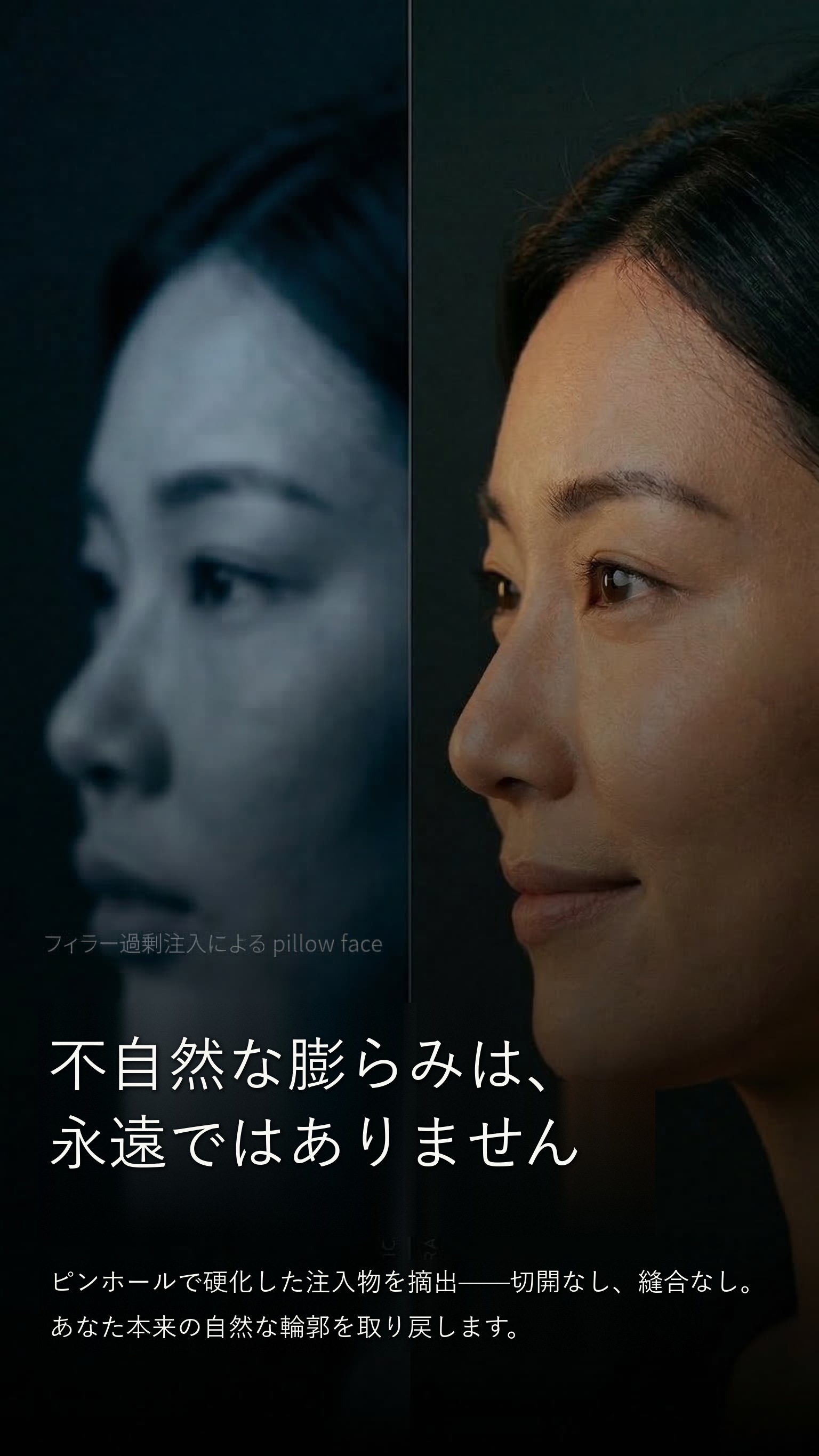 不自然な膨らみは、永遠ではありません — ピンホール微創手術で硬化した注入物を除去。