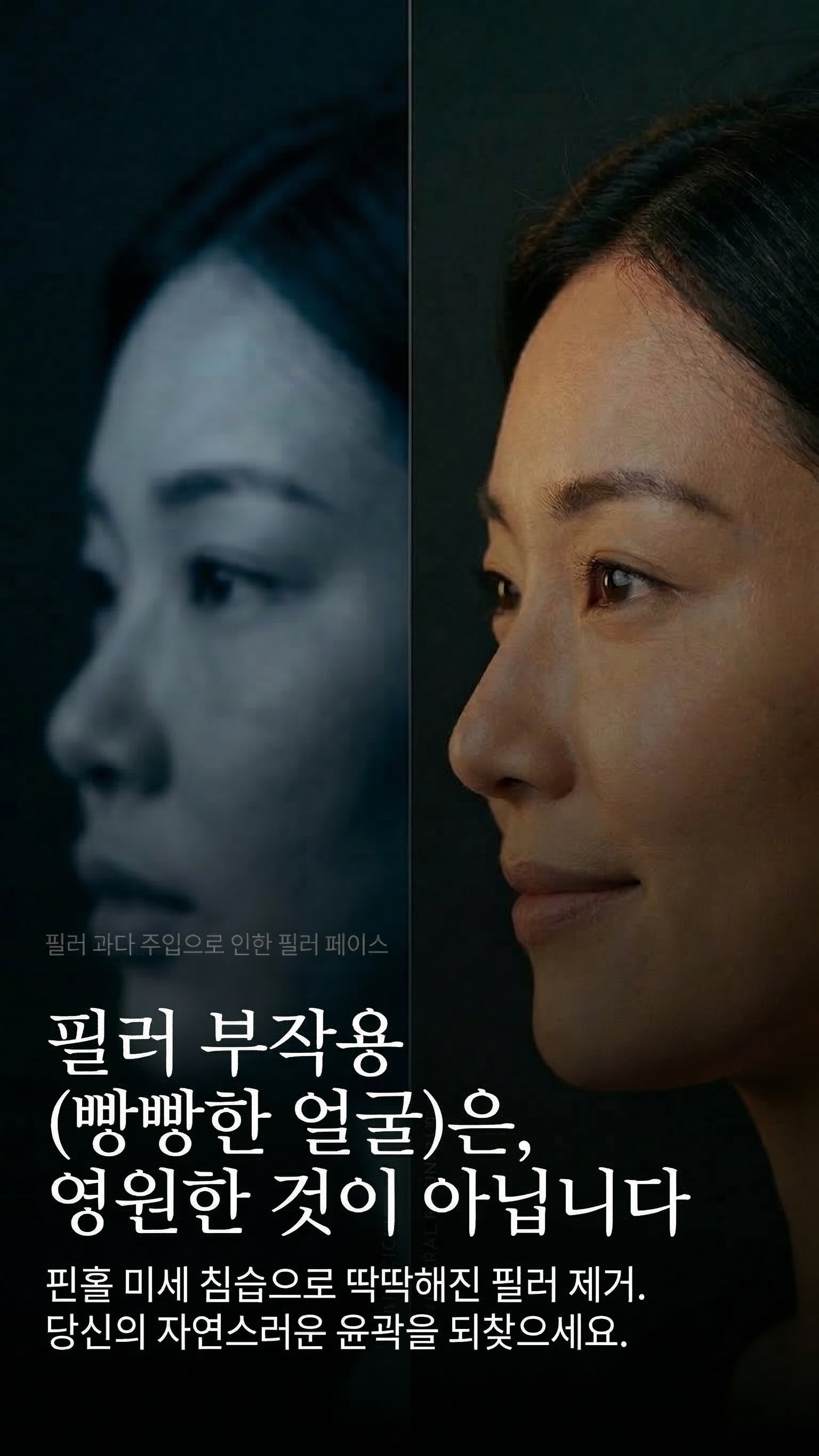 필러 부작용, 영원한 것이 아닙니다 — 핀홀 미세 침습으로 딱딱해진 필러 제거.