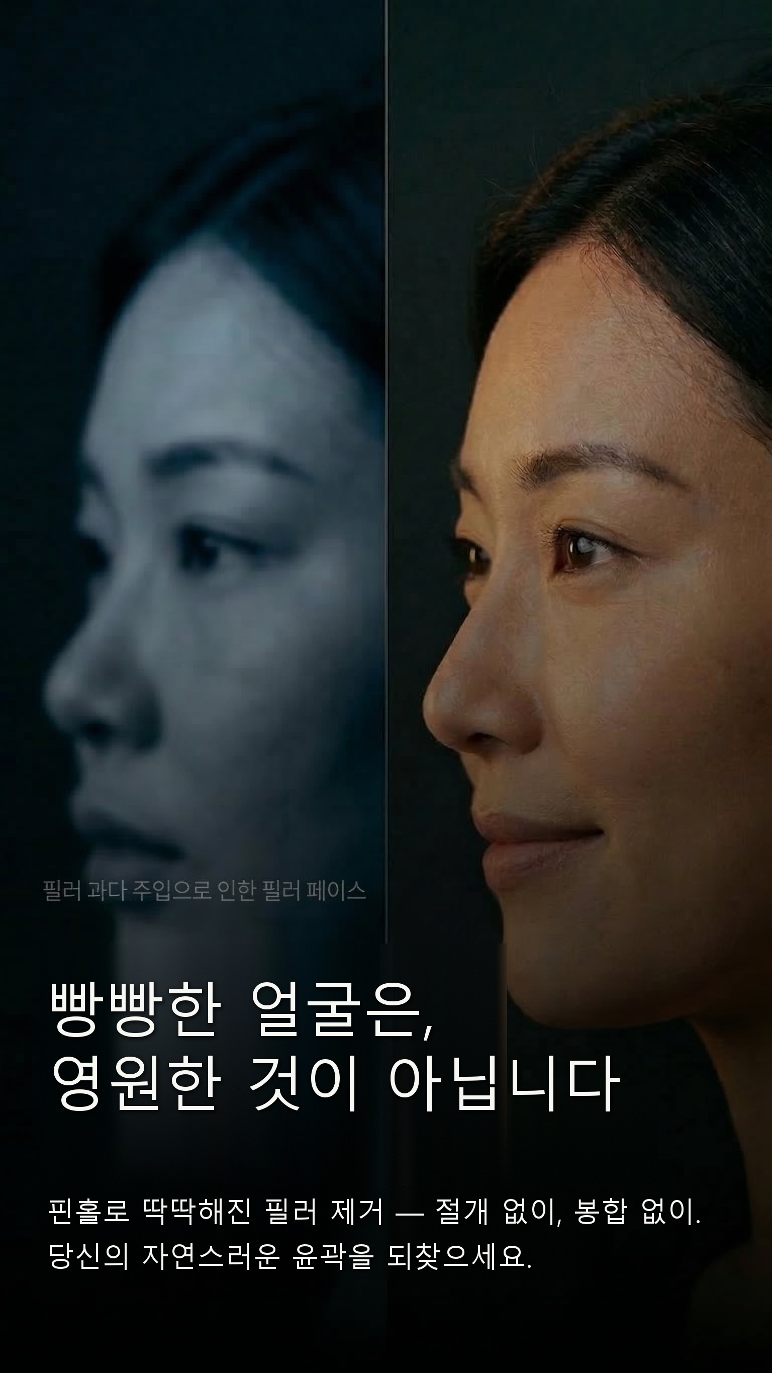 빵빵한 얼굴은, 영원한 것이 아닙니다 — 핀홀 미세 침습으로 딱딱해진 필러 제거.
